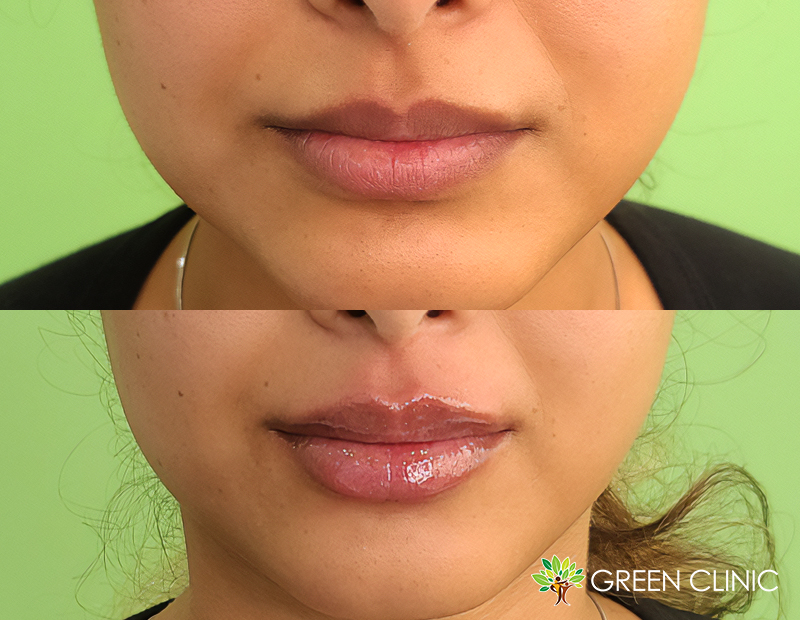 Lip Filler_Before and After